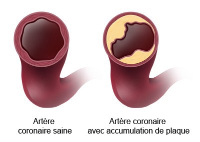Dépôts réduisant le calibre de l'artère Athérosclérose