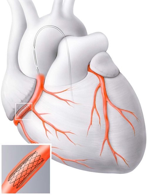 Stent Stent